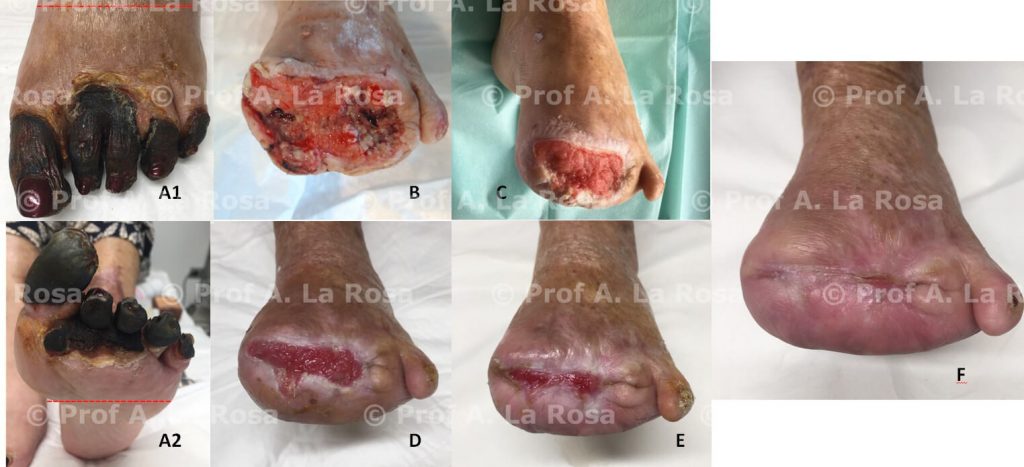 Complicanza settica accompagnata da embolizzazione alle dita del piede
