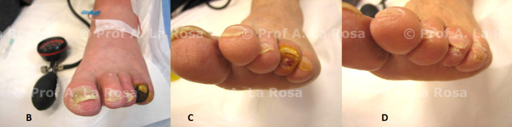 caso clinico necrosi ischemia critica terapia