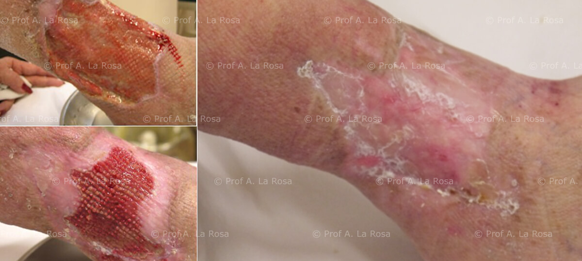Ulcere cutanee: nuovo metodo integrato per la rigenerazione guidata dermo-epidermica