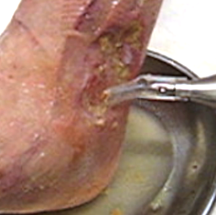 cura e detersione ulcera flebostatica sovramalleolare